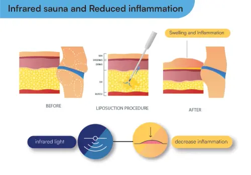 Infrared Sauna After Liposuction 2.webp