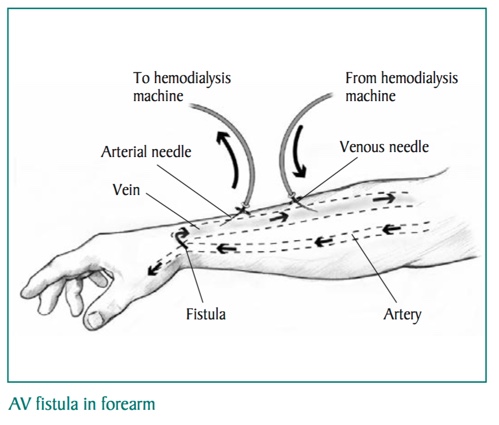 AV fistula in forearm.jpg