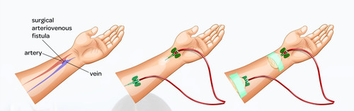 Haemodialysis access with an arteriovenous fist.original.jpg