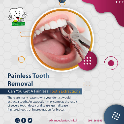 Painless Tooth Removal.jpg