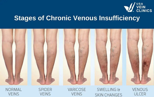 Chronic Venous Insufficiency Stages.jpg