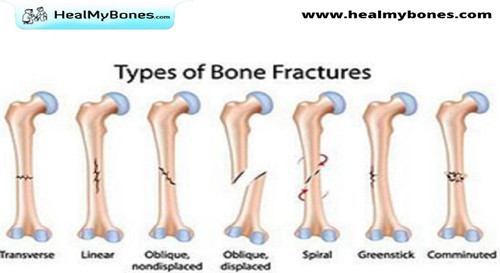 Heal My Bones: Best Treatment for Fracture Care in Kolkata.jpg