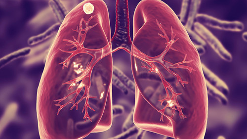 tuberculosis.jpg