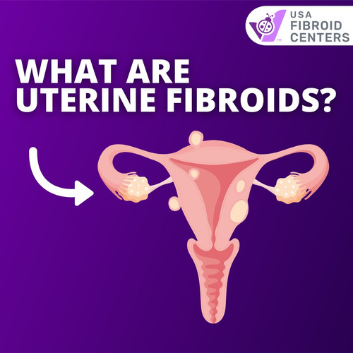 What are Uterine Fibroids?.jpg