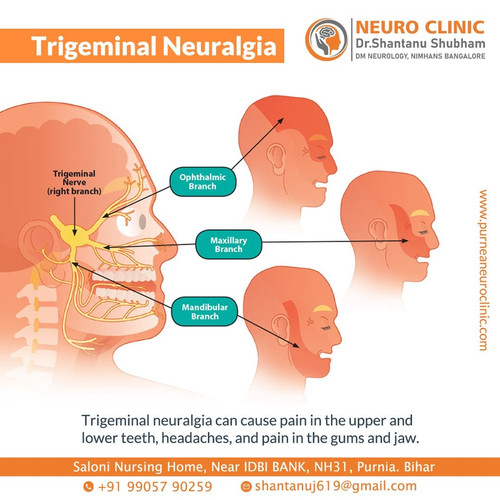 Trigeminal neuralgia - Neurologists in Purnia.jpg