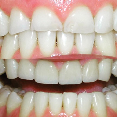 Dental Implants La Mesa.jpg