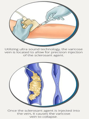 Visual Sclerotherapy 2.jpg