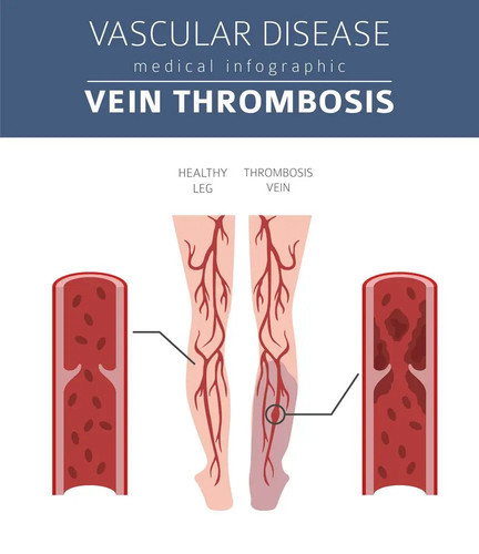 Vein Thrombosis.jpg