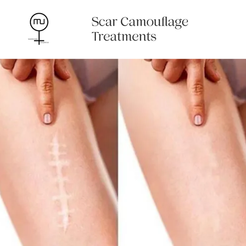 A safe tattooing technique called "scars camouflage" fills in some scars with skin-tone-compatible pigments. For a precise cost and procedure time estimate, we provide a free first consultation. Call us at 918851988598 If you want know to more please visit our website shorturl.at/auKW3