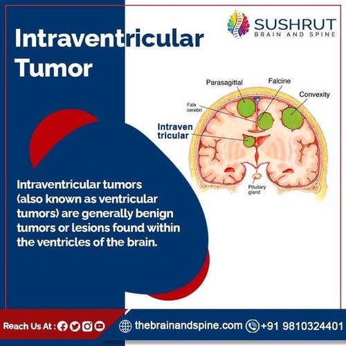 Intraventricular Tumor.jpg