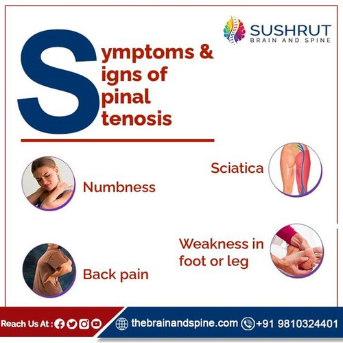 Symptoms and signs of spinal stenosis.jpg