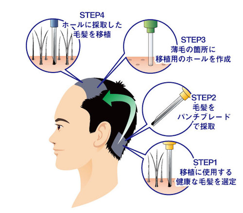 transplant mechanism02.jpg