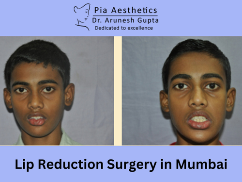 Lip Reduction Surgery in Mumbai.png