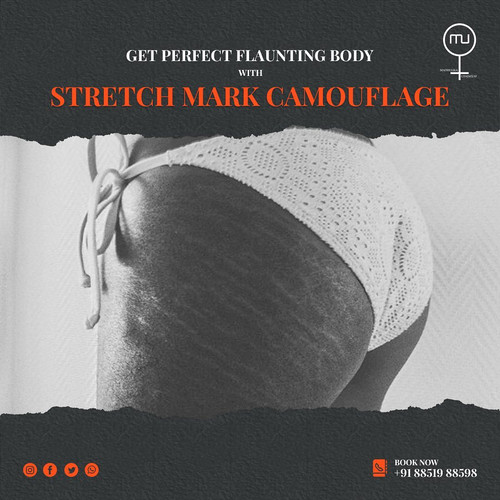 Stretch mark camouflage is a term that refers to a number of cosmetic procedures designed specifically to hide stretch marks. Call us at +1-866-962-3224. If you want know more please visit our website shorturl.at/bAFPW