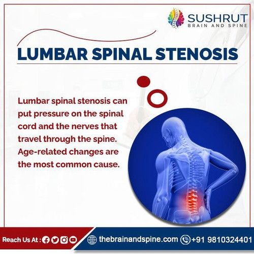 LUMBAR SPINAL STENOSIS.jpg
