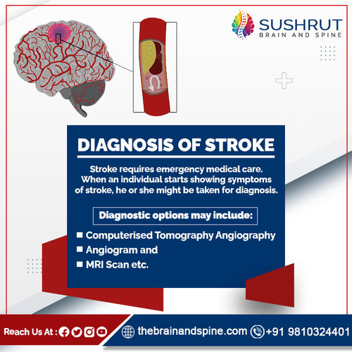 DIAGNOSIS OF STROKE.jpg