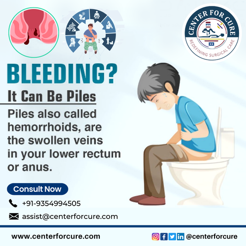 Piles Laser Treatment.png