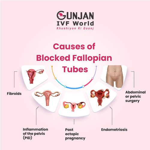 Causes of Blocked FAllopian Tubes.jpg
