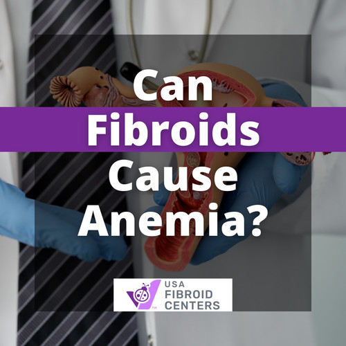 Can Fibroid Cause Anemia.jpg