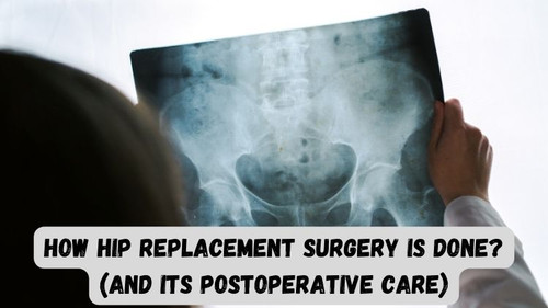 How Hip Replacement Surgery is Done? (And Its Postoperative Care).jpg
