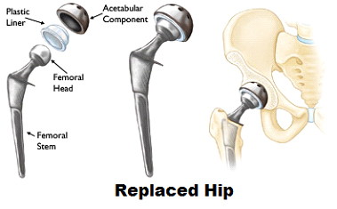 Trusted Hip Replacement Surgeon in Kolkata: Dr. Manoj Kumar Khemani.jpg