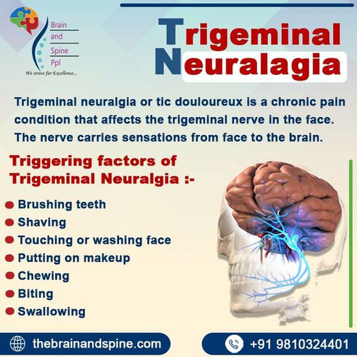 Trigeminal neuralgia.jpg