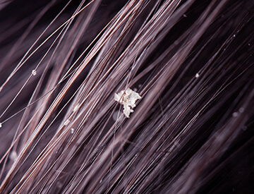 Best dandruff treatment in Dubai - Dr Batra’s Homeopathy.jpg