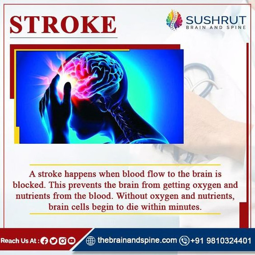 Treatment for a stroke.jpg