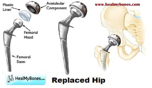 Trusted Hip Replacement Surgeon in Kolkata: Dr. Manoj Kumar Khemani.jpg