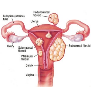 Pictures Of Fibroids.jpg
