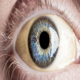 ictericia (1)