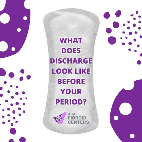 Wondering about clear discharge before your period? During the menstrual cycle, most women experience various forms of clear discharge before their period and wonder if discharge before the period is expected. Here is everything you need to know about discharge before your period!
https://www.usafibroidcenters.com/blog/what-does-discharge-look-like-before-your-period/