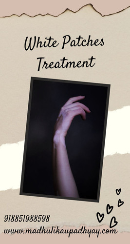 Suffering from white patches, and now looking for treatment? You came to the right place, madhulikaupadhyay will help you. Vitiligo Treatment or White Patches Treatment is based on improving your skin’s appearance by restoring its colour. Book your appointment now and call us at 918851988598
https://bit.ly/3wtBuwZ