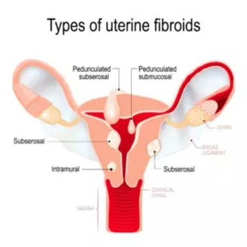 Intermural Fibroid Symptom and Treatments.jpg