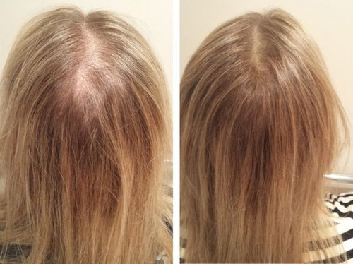 queda cabelo feminino tratamento.jpg