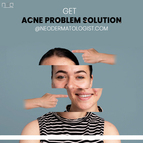 Spot and acne treatment for face and body, prevent pimples and promote rapid recovery.jpg