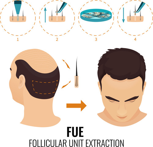 FUE Hair Transplant Process.jpg