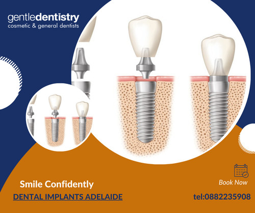 dental implants adelaide.jpg