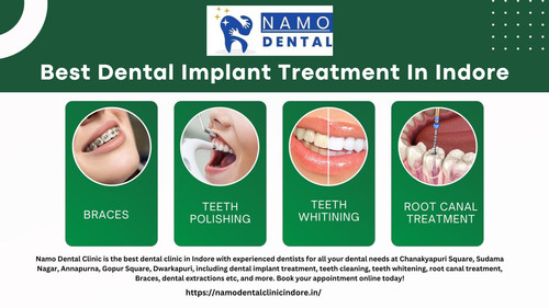 Best Dental Implant Treatment In Indore.jpg