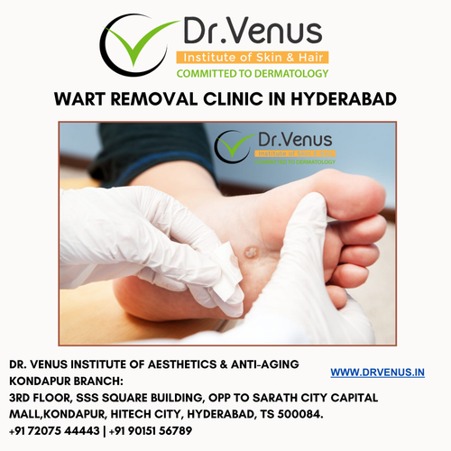 wart removal clinic in Hyderabad.png