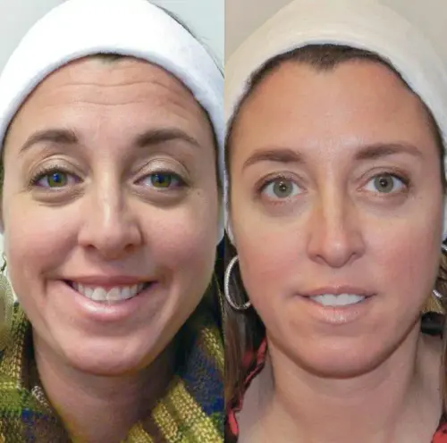 Aplicacao de Botox em Moema SP 1024x1015.webp