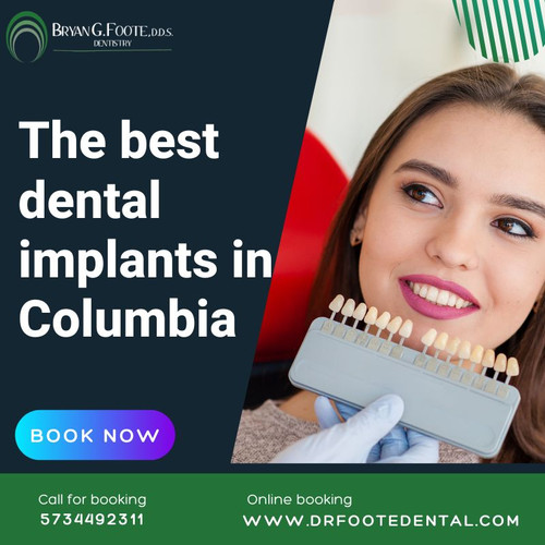 The best dental implants in Columbia.jpg