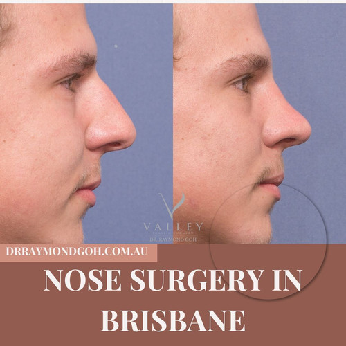Nose Surgery in Brisbane.jpg