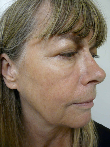jowl lift 02.jpg