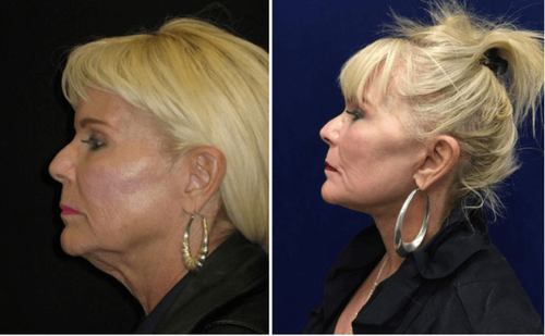 Facelift Walnut Creek CA 600x371.png
