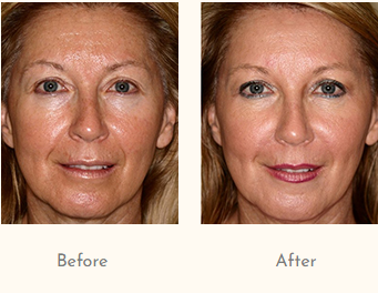 Best Botox Treatment in Mumbai.png