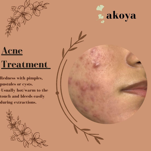 Acne Treatment.jpg