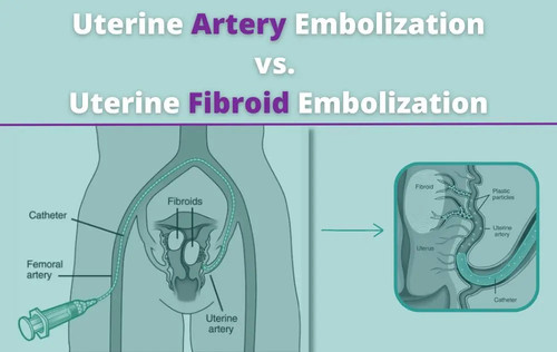 Uterine Artery Embolization: A Minimally Invasive Solution for Fibroid Treatment.jpg