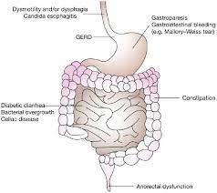 Effects of diabetes on gastrointestinal system.jpg