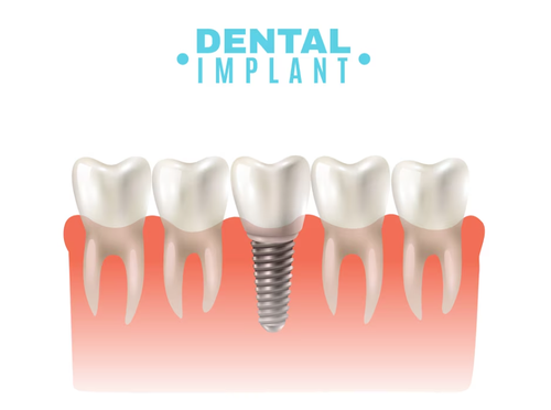 dental implants in delhi.png